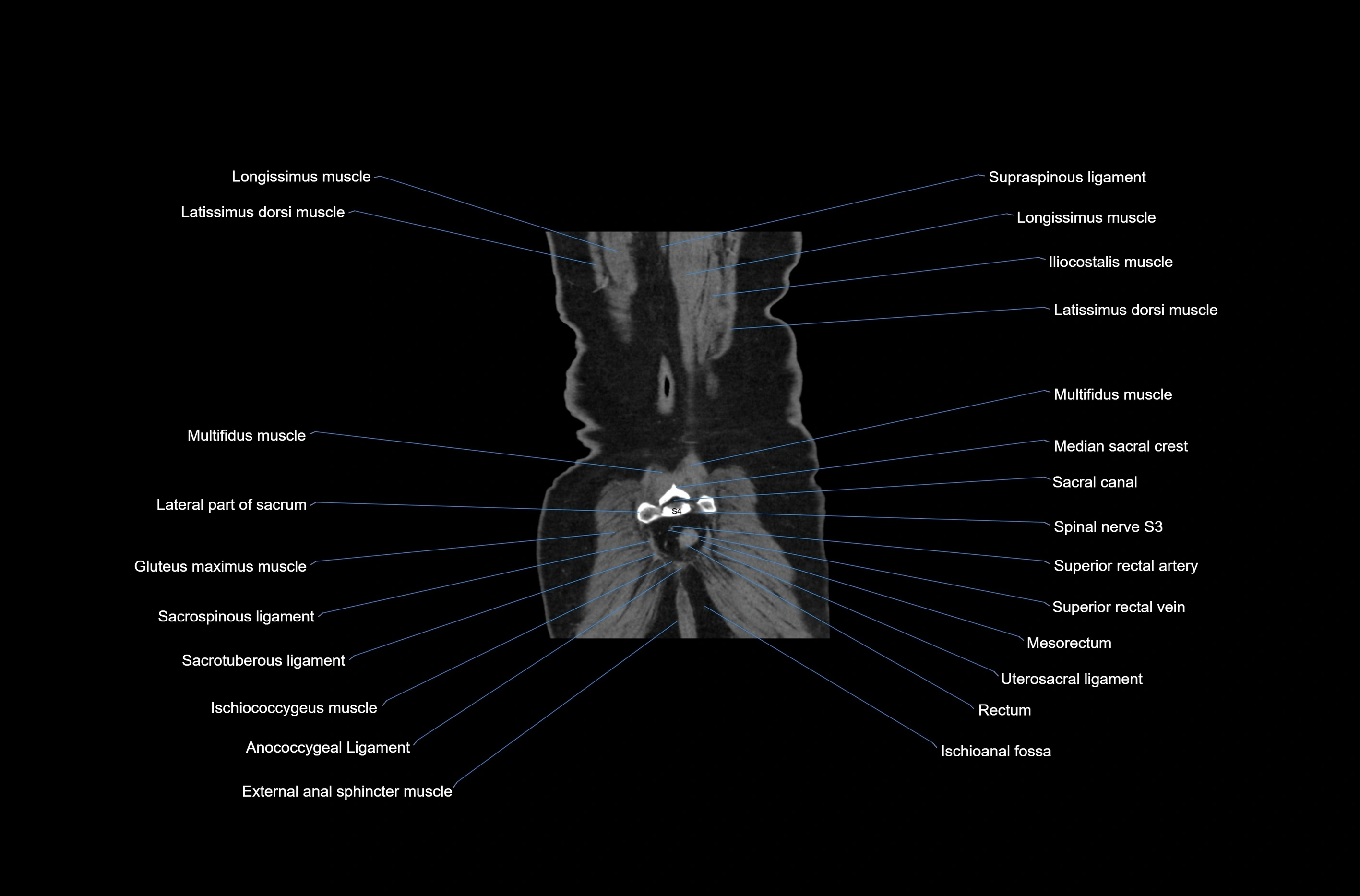 CT abdomen coronal cross sectional anatomy labelled radiology image-00079.webp